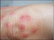 Bed-Bug-Bite-Elbow Bed-Bug-Bite-Elbow